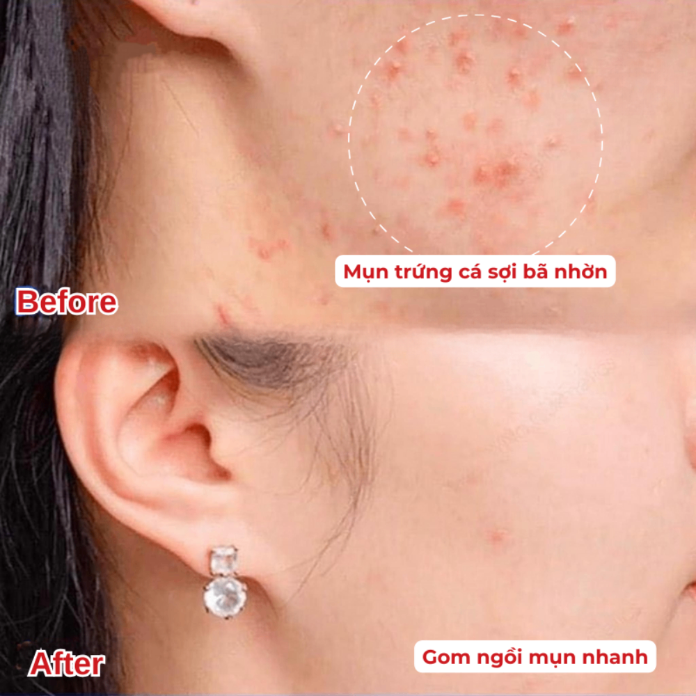 Kem Retacnyl Tretinoin 0.025%/0.05% 30g giảm mụn trứng cá, cải thiện lão hóa da