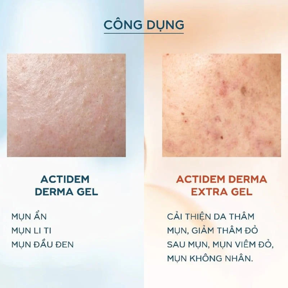 Gel giảm mụn Actidem Derma Extra Gel 18g giúp làm giảm mụn nhanh chóng