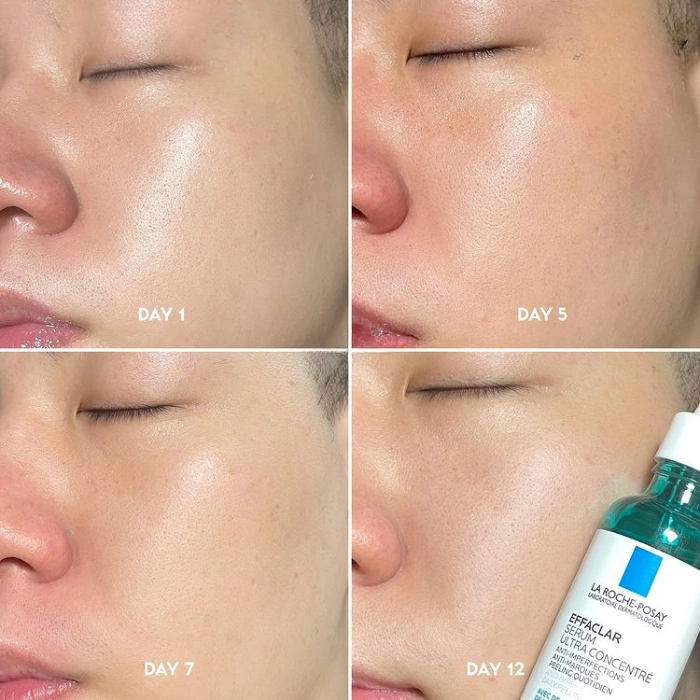 Tinh Chất Laroche Posay Effaclar Ultra Concentrated Serum 30ml