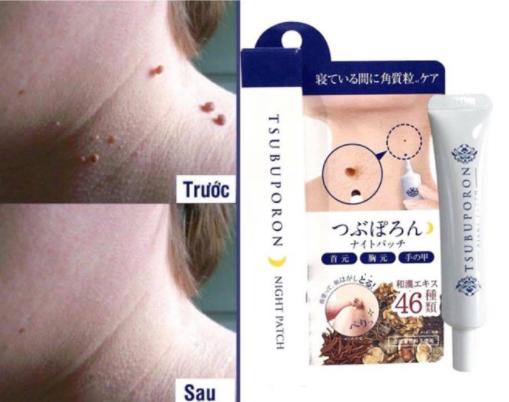 Kem xóa nốt ruồi Nhật TSUBUPORON 20g