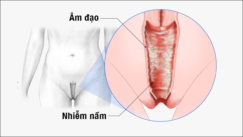 -Co-be-ngua-ngay-khi-hu-bat-thuong-Canh-bao-do-tu-vung-kin--3.jpg
