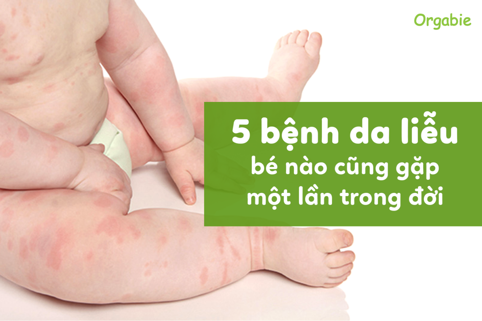 5 bệnh về da phổ biến ở trẻ và hậu quả khôn lường nếu mẹ lơ là