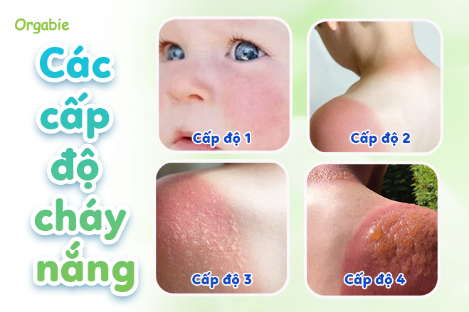 Cấp độ cháy nắng mẹ cần nắm
