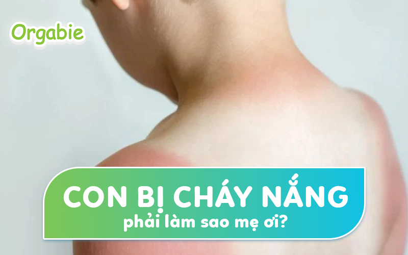 Con bị cháy nắng, ba mẹ nên làm gì?