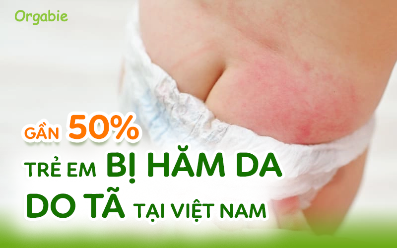Hăm da ở trẻ nhỏ: Cách phân biệt và xử lý theo từng mức độ