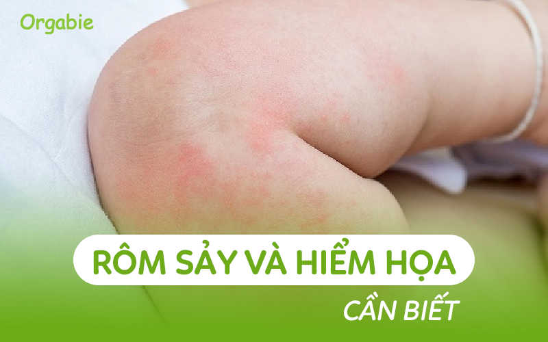 Cha mẹ cần hiểu rõ về rôm sảy ở trẻ