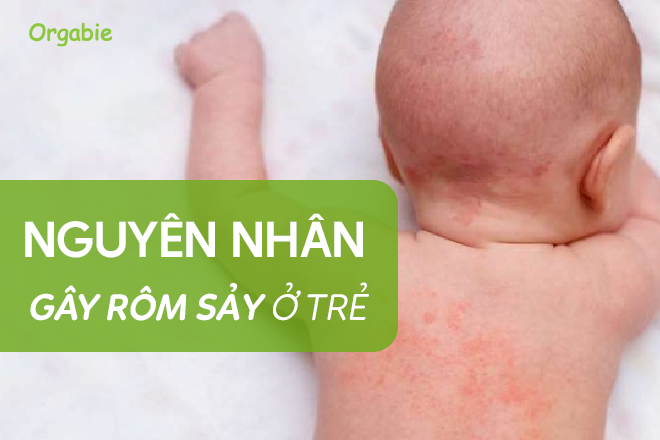 Kiến thức về Rôm sảy, cha mẹ cần hiểu đúng đề tránh hiểm hoạ