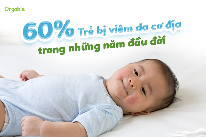Mẹ đừng chủ quan khi con bị viêm da cơ địa