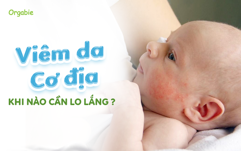 Viêm da cơ địa mùa hè: Khi nào cần lo lắng?