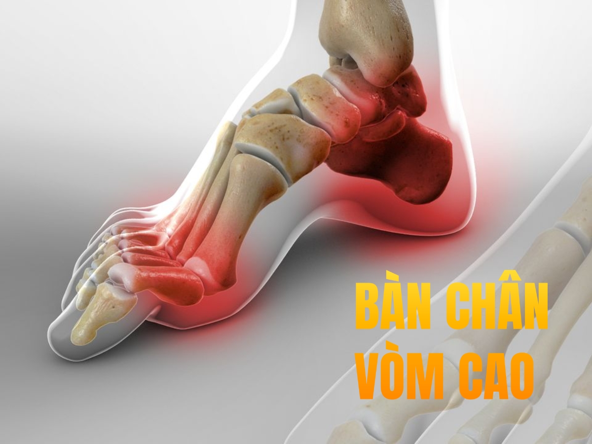 Lót Giày Thể Thao Cho Bàn Chân Vòm Cao (Chân High Arch)