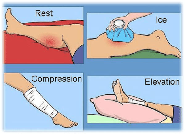 Phương pháp trị liệu R.I.C.E