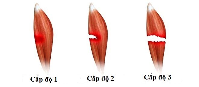 Các cấp độ đau bắp chân