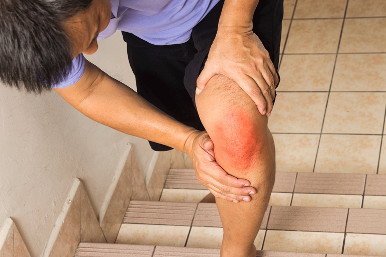 Đau khớp gối khi leo cầu thang - lý do nhiều người tìm đến sản phẩm chứa corticoid
