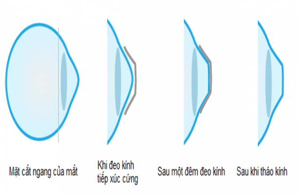 Kính áp tròng cứng là gì? - Liệu bạn đã biết về loại kính áp tròng này?