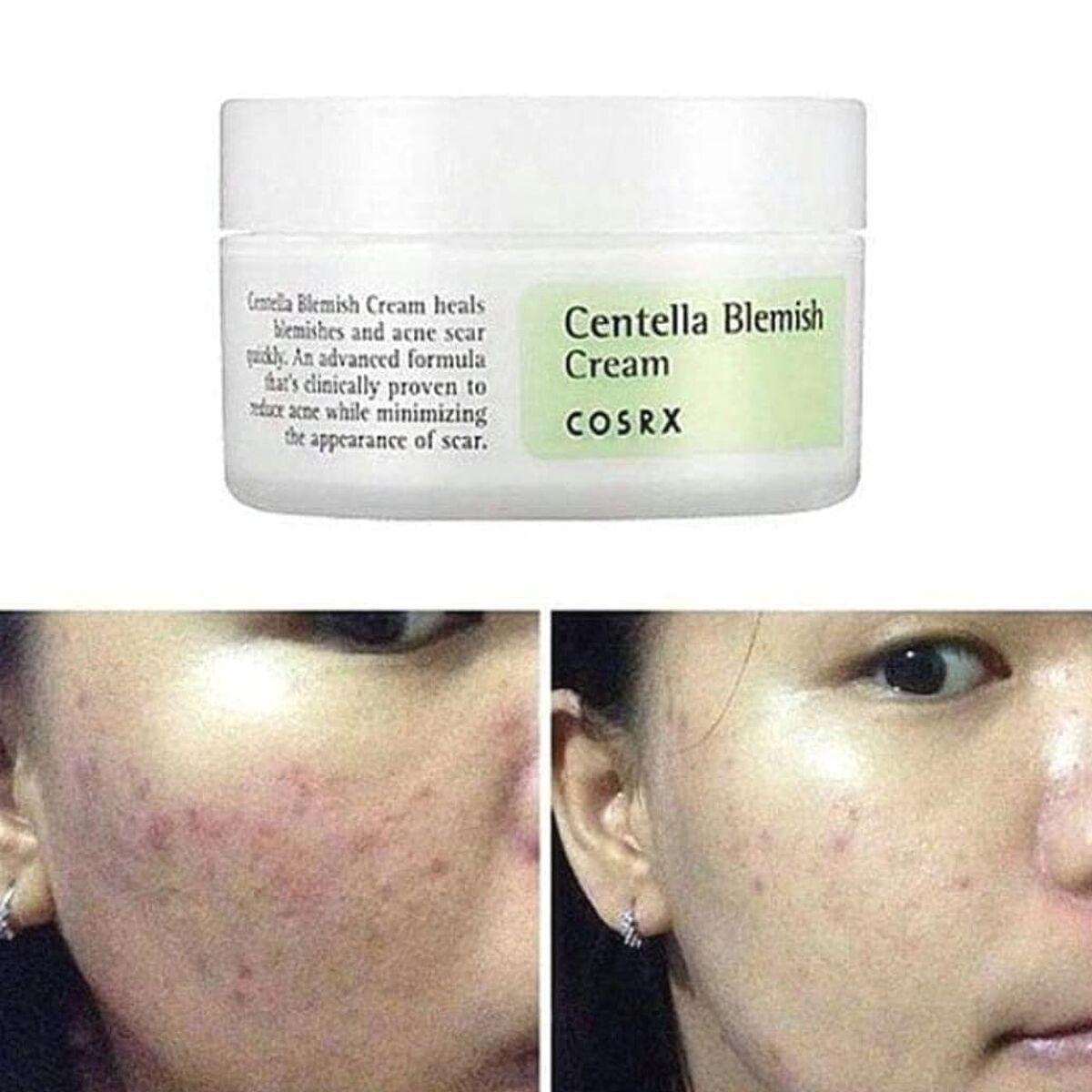 Kem dưỡng Cosrx Centella Blemish Cream trị mụn 30g 1t72