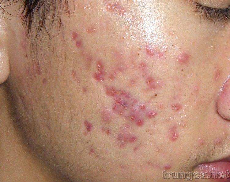 Tất tần tật về mụn trứng cá