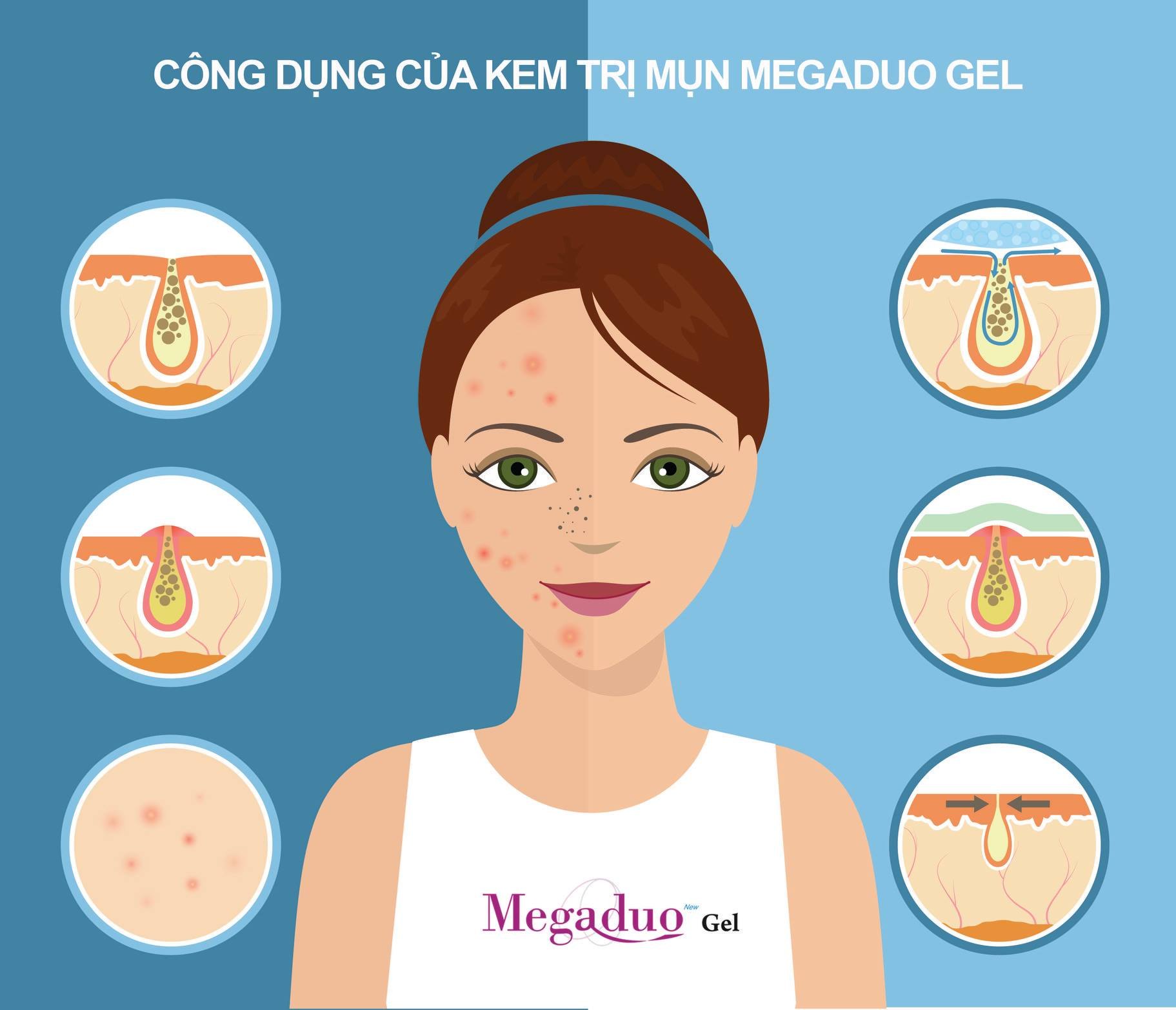 Gel trị mụn Megaduo 15g