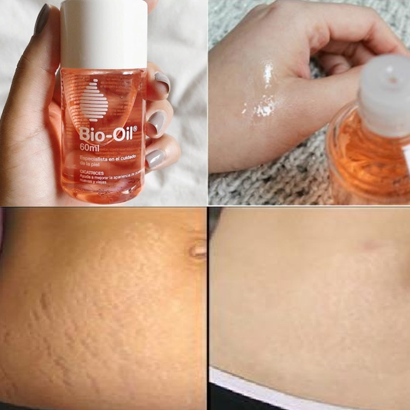 DẦU TRỊ RẠN BIO OIL