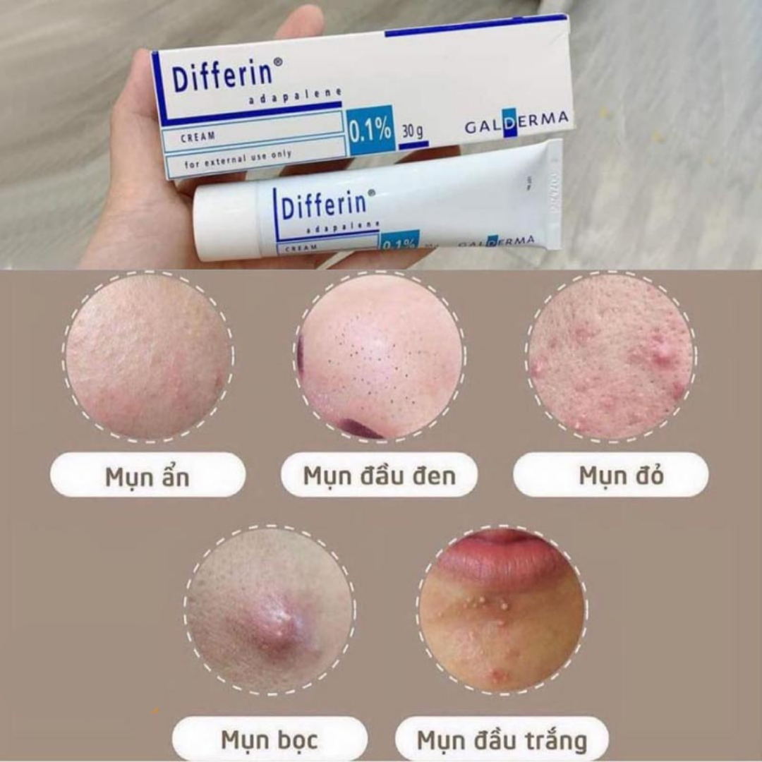 Kem Trị Mụn Differin Pháp dạng cream