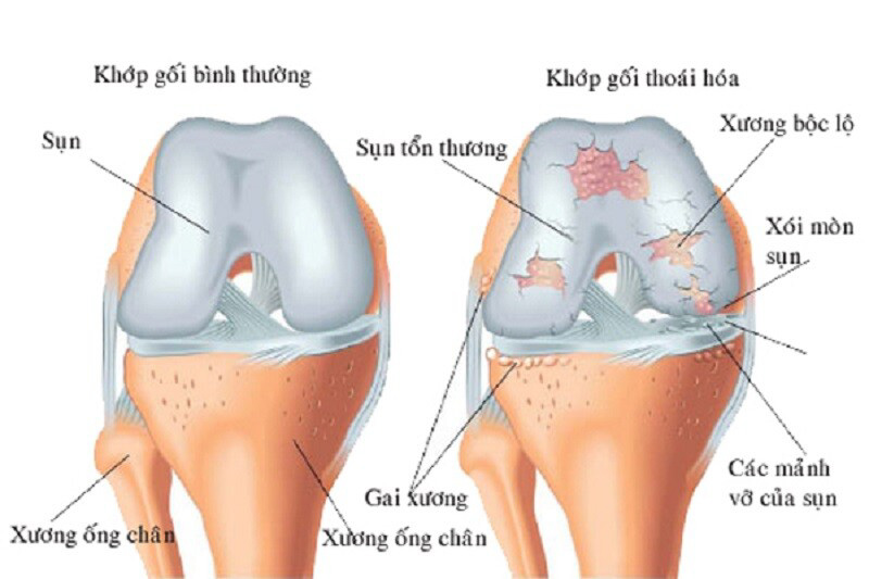 Thoái hoá khớp