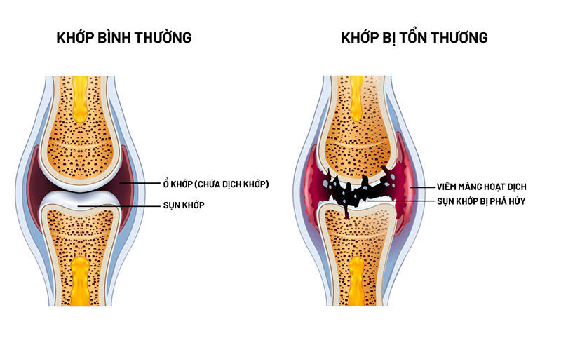 Lợi ích của glucosamine đối với xương khớp