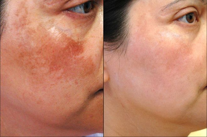 Vì sao Serum trị nám Murad được nhiều chị em tin dùng?