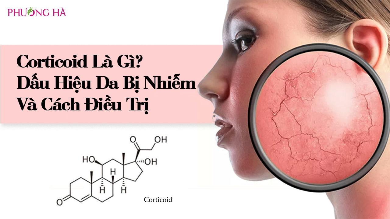 Corticoid Là Gì? Dấu Hiệu Da Bị Nhiễm Corticoid Và Cách Điều Trị