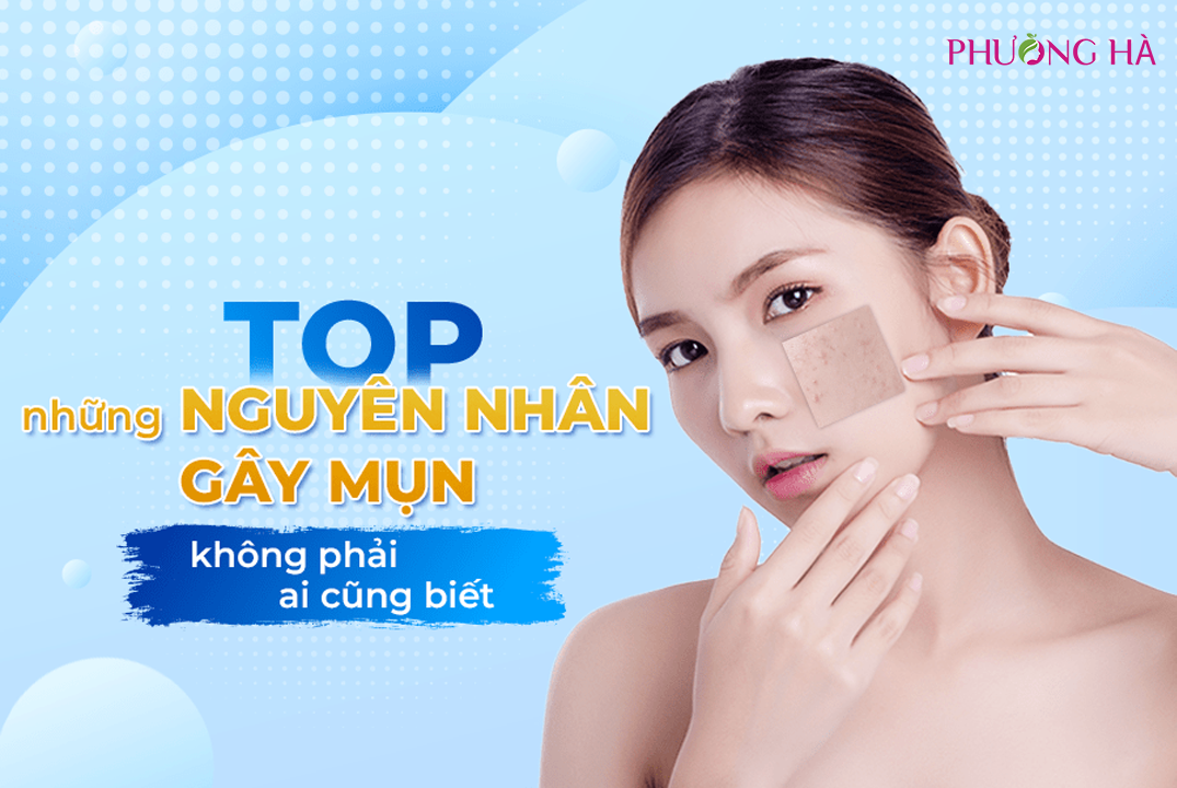 Nguyên Nhân Gây Mụn Là Gì? 8 Nguyên Nhân Gây Mụn Phổ Biến