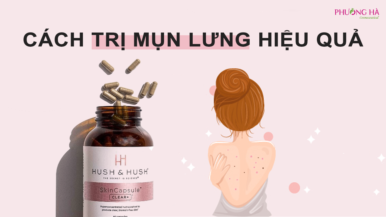 Cách Trị Mụn Lưng Hiệu Quả Nhất 2023