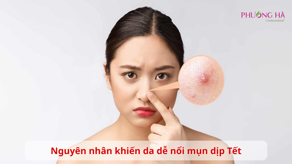 Bo-tui-tuyet-chieu-duong-da-ngua-mun-ngay-Tet-ma-chi-em-can-biet-1.png