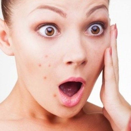 Top 9 nguyên nhân gây mụn bất ngờ bạn cần biết