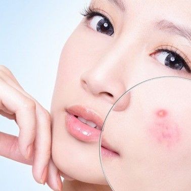 Bạn đã tiêu dùng khôn ngoan khi chăm sóc da mụn chưa?