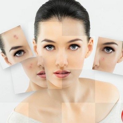 11 lời khuyên dành cho da mụn