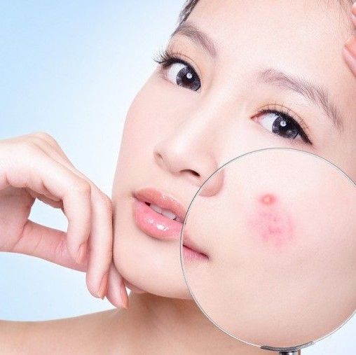Bí quết và quy tắc chăm sóc da ngăn ngừa mụn hiệu quả