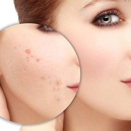 9 sản phẩm trị mụn thâm tốt bất ngờ và trị mụn bằng laser