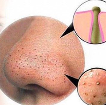 Top 10 cách loại bỏ mụn đầu đen hiệu quả