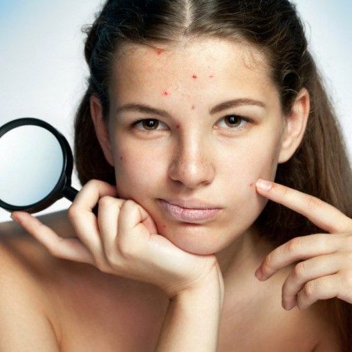 Làm Sao Để Trị Mụn Đường Chân Tóc Dứt Điểm