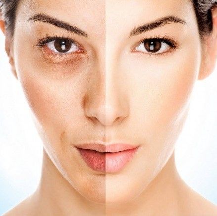 Melanin có phải là nguyên nhân gây sạm nám? Bật mí sự thật về thuốc trị nám trắng da