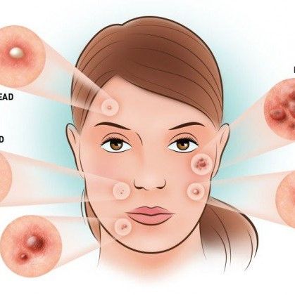Những sai lầm phổ biến khi trị mụn nội tiết và cách khắc phục