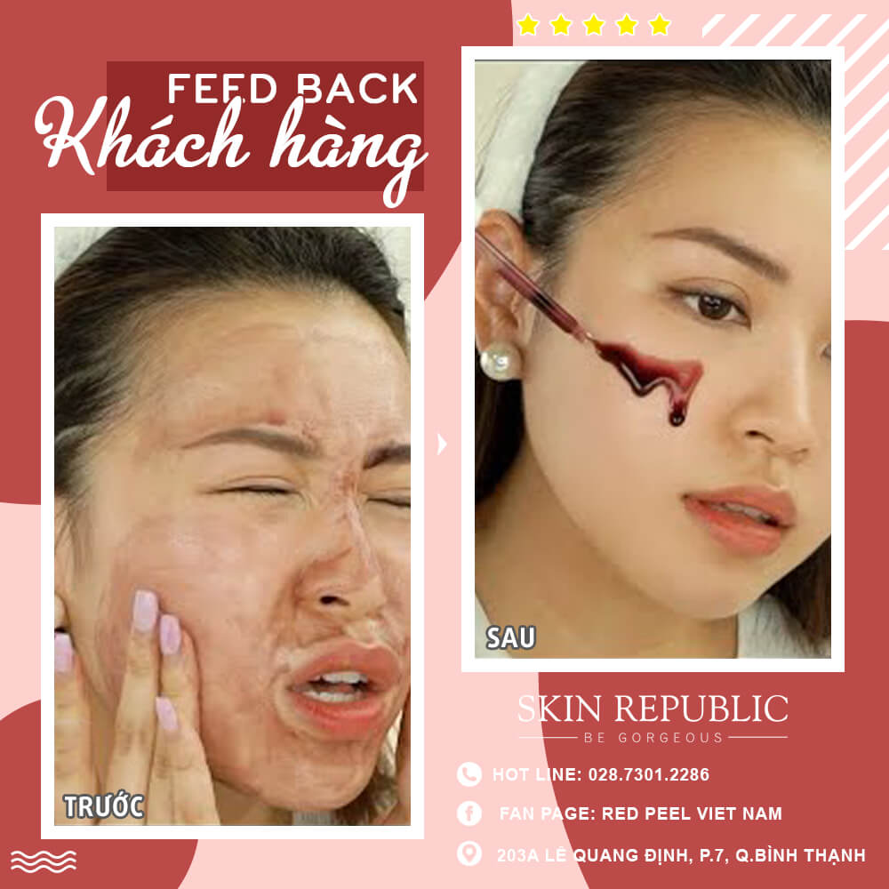 Combo trị mụn dưỡng trắng Red peel tingle serum - milk oil skin booster