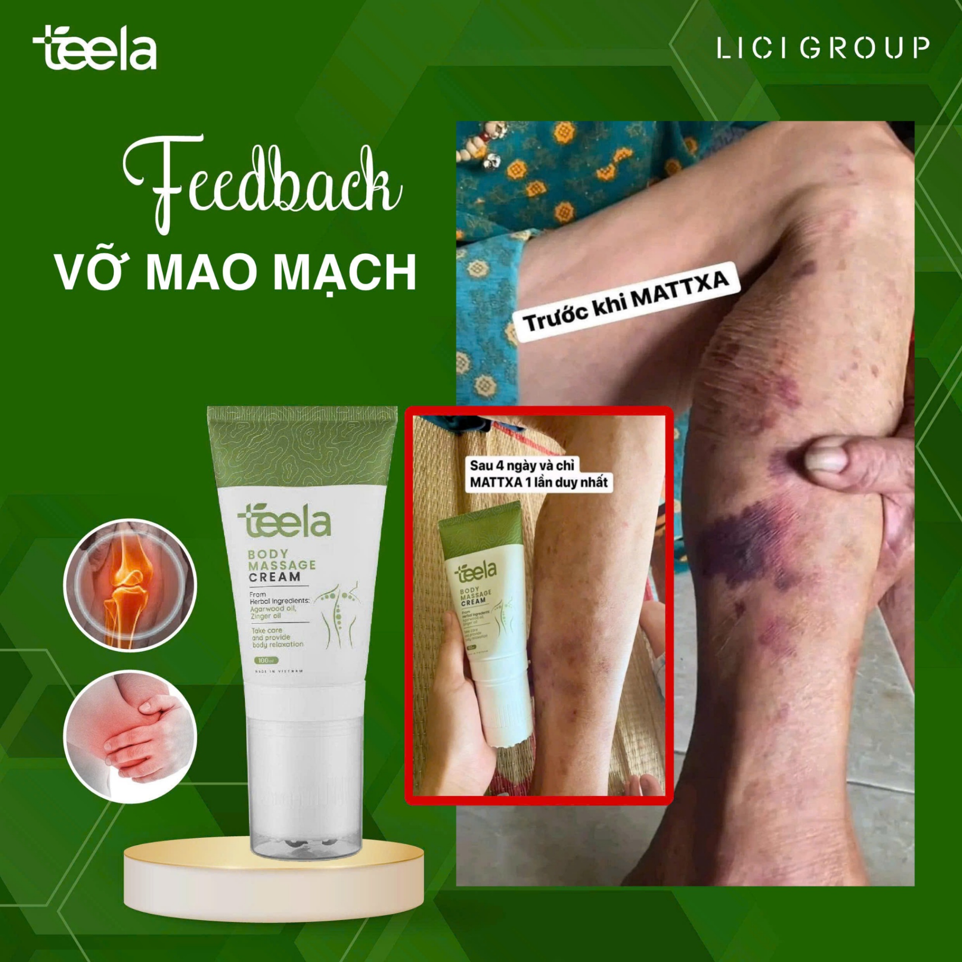 Kem massage Teela giảm đau cơ xương khớp