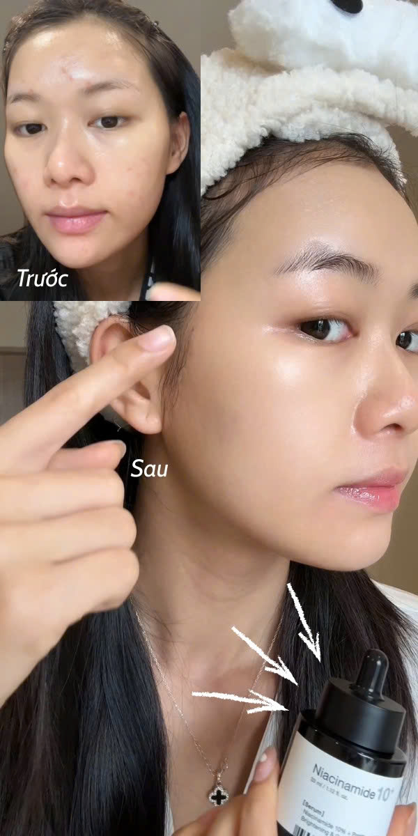 Tinh Chất Làm Trắng Và Thu Nhỏ Lỗ Chân Lông Anodin Niacinamide 10 Plus Serum