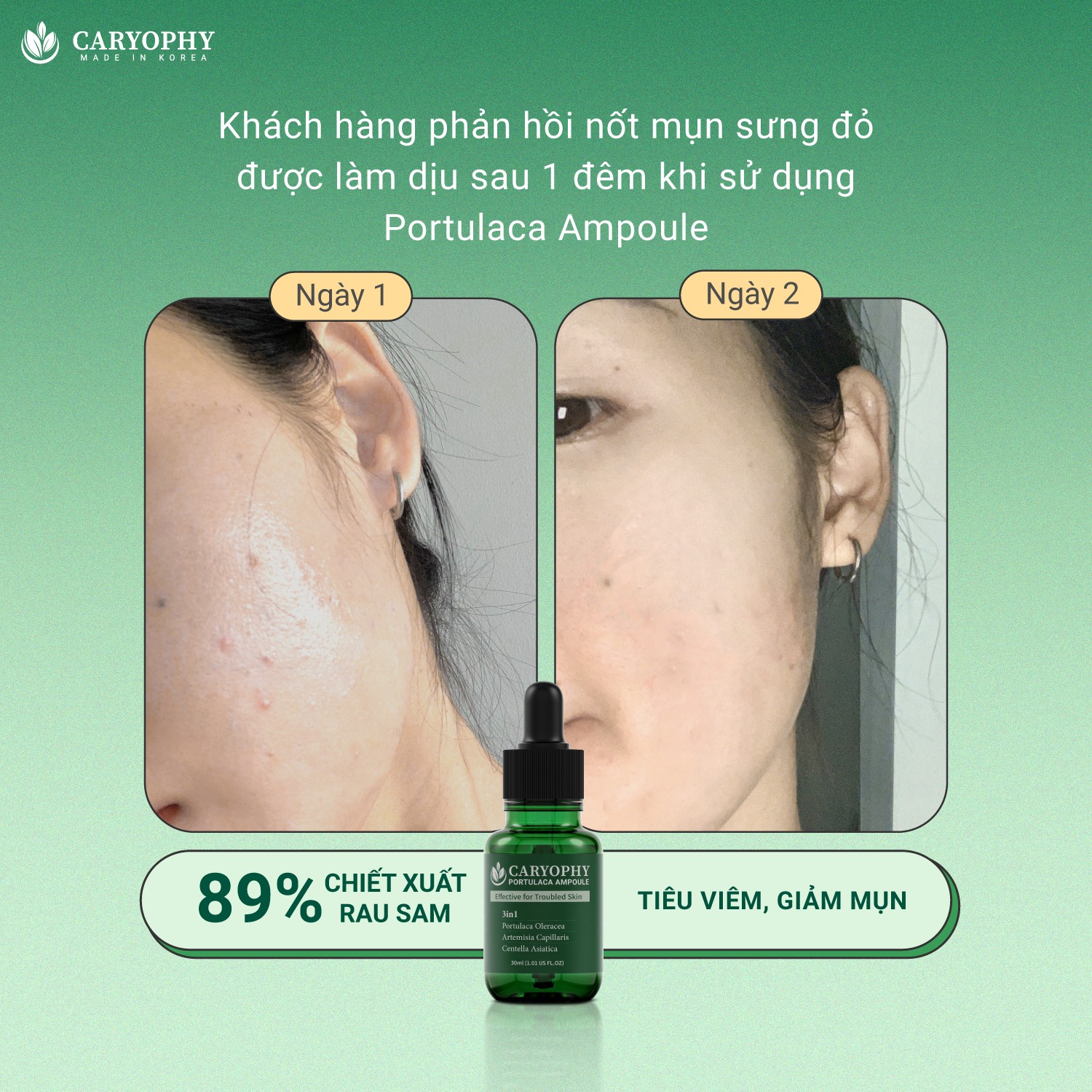 Serum Caryophy Portulaca Ampoule – Tinh Chất Giảm Mụn, Mờ Thâm Hiệu Quả Từ Hàn Quốc 30ml