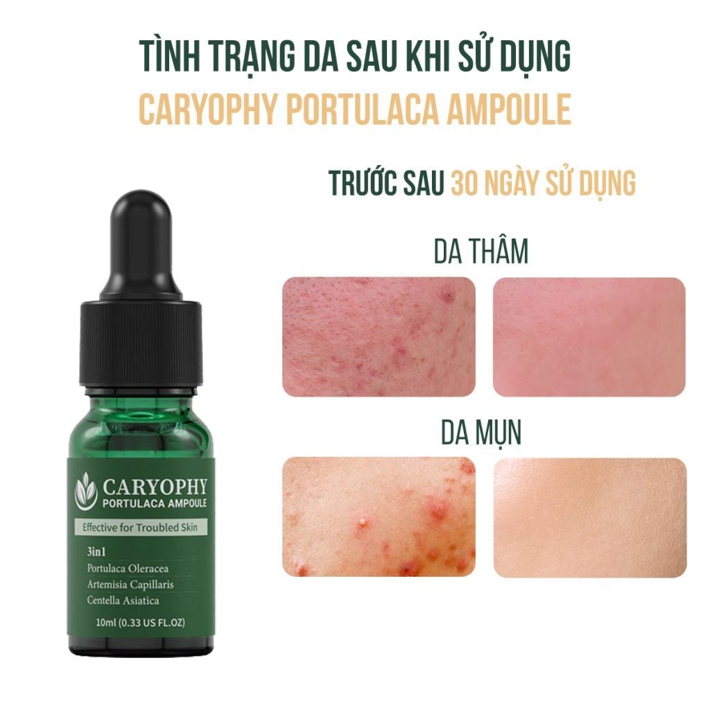 Serum Caryophy Portulaca Ampoule – Tinh Chất Giảm Mụn, Mờ Thâm Hiệu Quả Từ Hàn Quốc 30ml