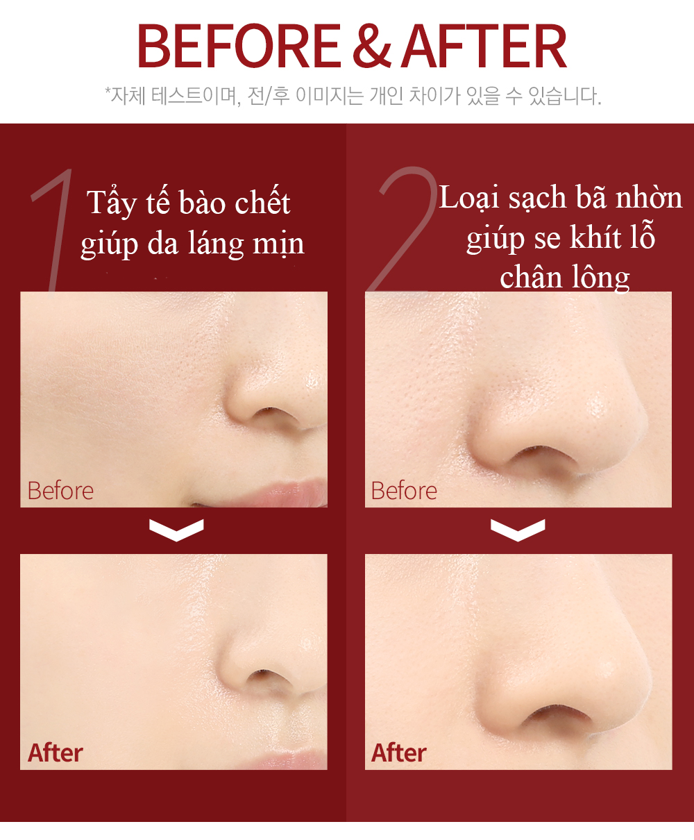 serum trị mụn, thay da sinh học, serum red peel