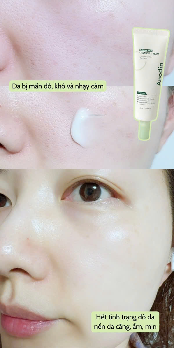 Kem-Duong-Lam-Diu-Va-Cap-Am-Cho-Da-Anodin-Kavakva-Calming-Cream_z6789594896681_cfbc90429ba2fcb322782f2bc3bec749.jpg