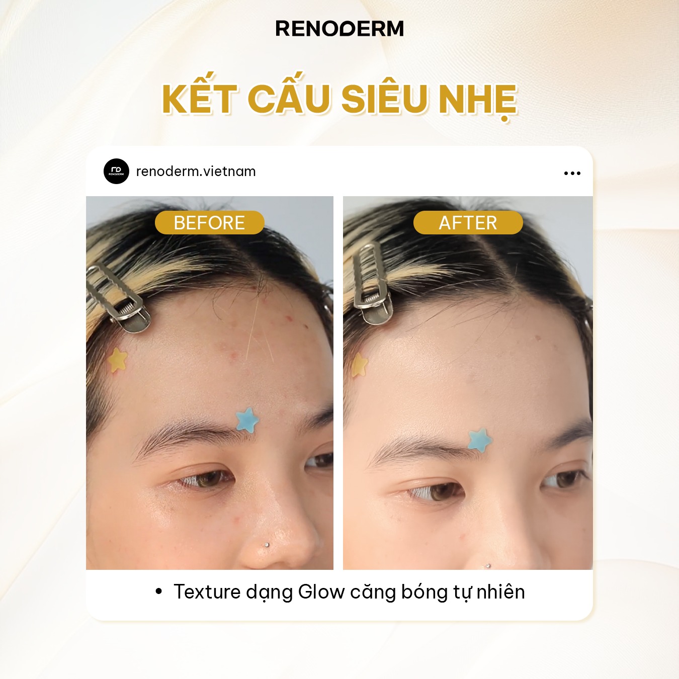 Phan-Nuoc-RO-RENODERM-Day-Long-BB-Cream-Glow-21-SPF-37-PA-Tone-Sang-2.jpg?v=1769664822